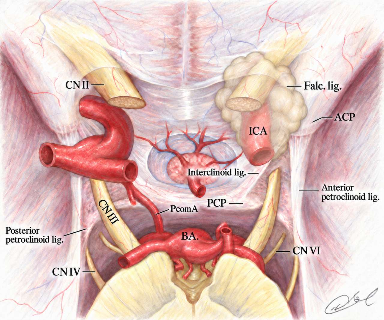 Colored-pencil illustration of skull-base anatomy, showing a large, pale, translucent meningioma over the anterior clinoid process on the right side of the image. The underlying optic nerve and internal carotid artery remain visible through the tumor. Labels identify cranial nerves, arteries, clinoid processes, and surrounding ligaments. A handwritten signature appears at the bottom right.