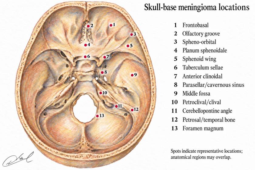Colour illustration of the skull base viewed from above, with thirteen red numbered dots marking representative meningioma locations from front to back. A matching legend identifies frontobasal, olfactory groove, spheno-orbital, planum sphenoidale, sphenoid wing, tuberculum sellae, anterior clinoidal, parasellar/cavernous sinus, middle fossa, petroclival/clival, cerebellopontine angle, petrosal/temporal bone and foramen magnum locations.